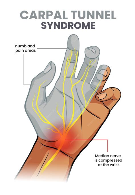 1. Carpal Tunnel Syndrome: