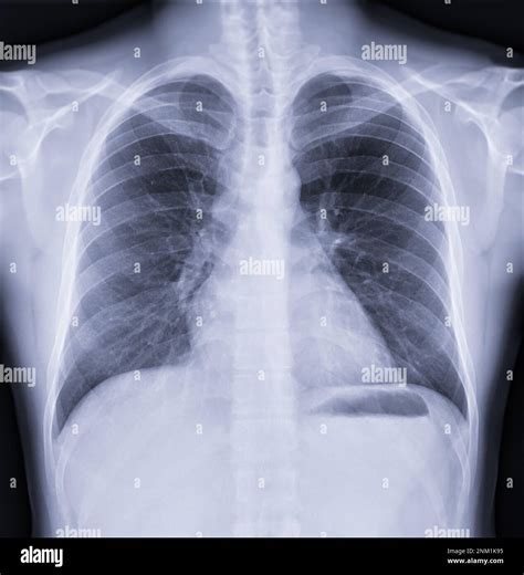 1. Chest X-ray