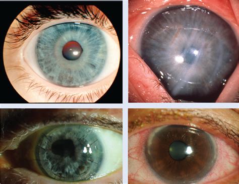 1. Cornea: