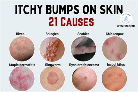 1. Eczema: The Itchy, Red Culprit (6.5M US Sufferers Annually)