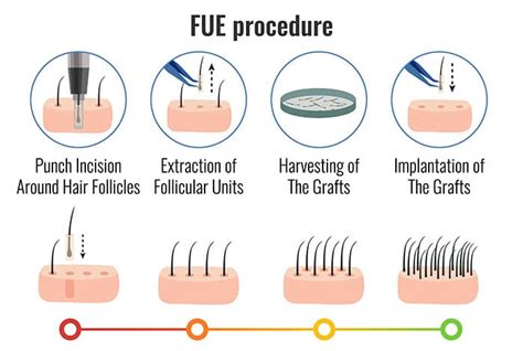 1. Follicular Unit Extraction (FUE)