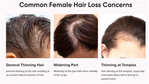 1. Growing Demand for Hair Loss Solutions