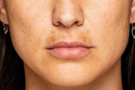 1. Hyperpigmentation: