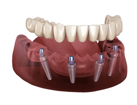 1. Implant-Based Augmentation: