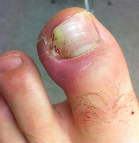 1. Ingrown toenail