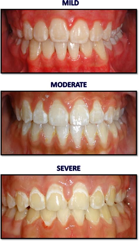 1. Initial White Spot (Demineralization)