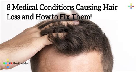 1. Medical Conditions and Hair Loss: