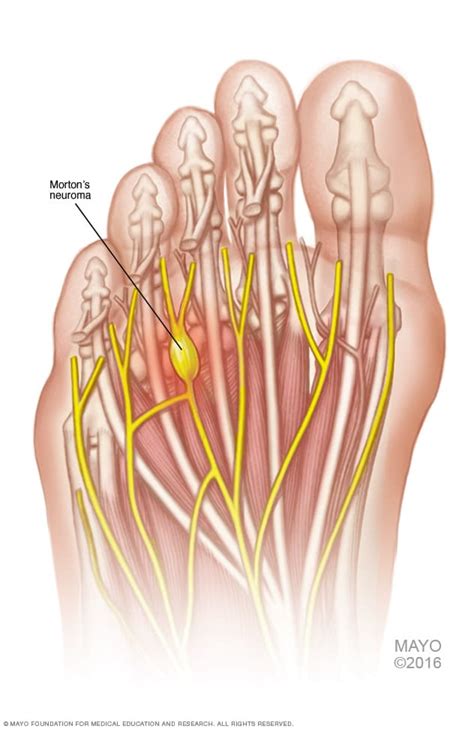 1. Morton's Neuroma: