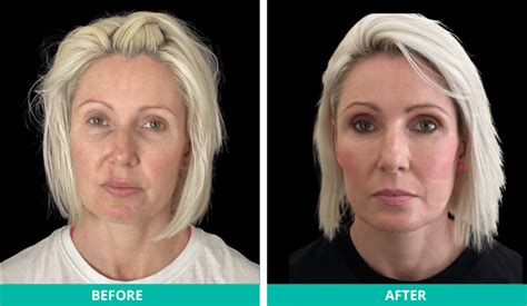 1. Natural-Looking Results That Last