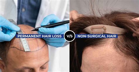 1. Non-Surgical Hair Replacement: Temporary Enhancements