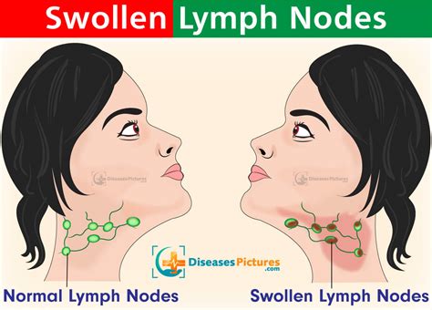 1. Persistent Swollen Lymph Nodes