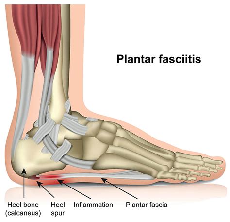 1. Plantar Fasciitis