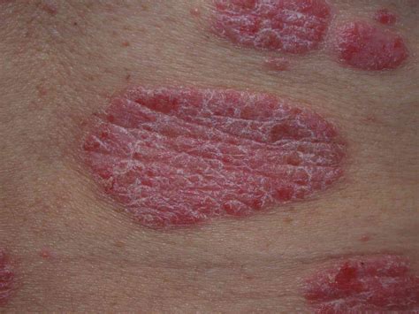 1. Plaque Psoriasis: