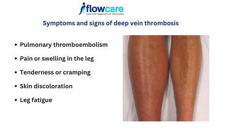 1. Reduced Risk of Deep Vein Thrombosis (DVT)