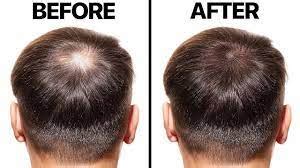 1. Regaining Confidence in Hair Loss: