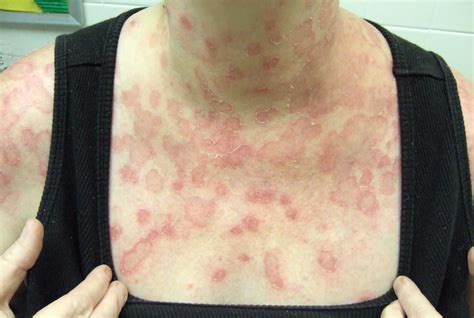 1. Ringworm (Tinea corporis)