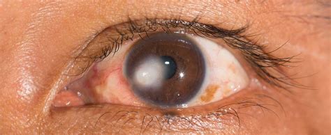 1. Scarred Eye: