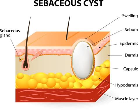 1. Sebaceous Cysts