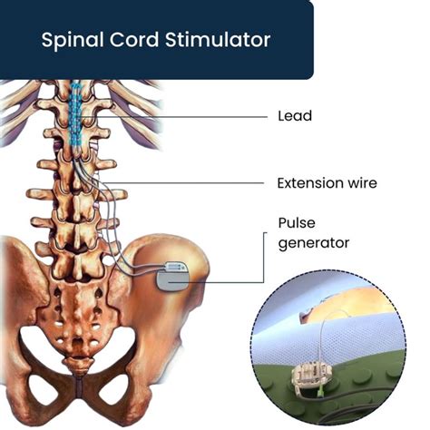 1. Spinal Cord Stimulation (SCS)