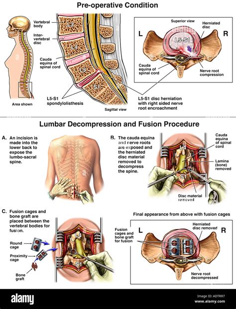 1. Spine Surgery