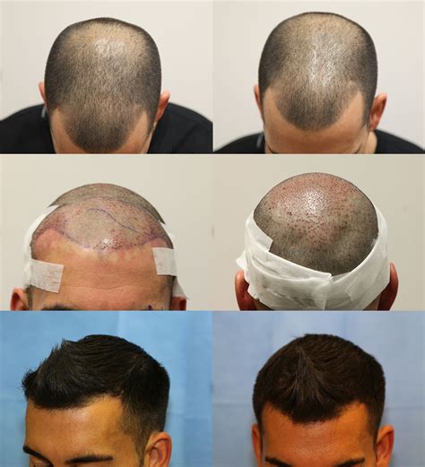 1. Surgical Hair Implantation: