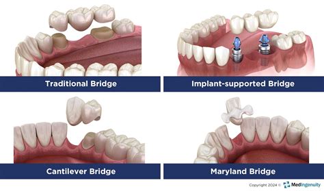 1. Traditional Dental Bridge: