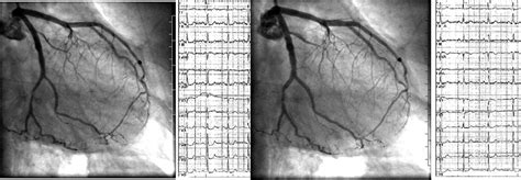 1. Transient Myocardial Ischemia