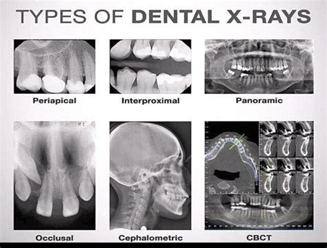 1. Type of X-Ray: