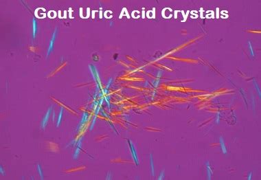 1. Uric Acid Crystals Can Cause Painful Symptoms