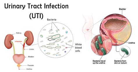 1. Urinary Tract Infections (UTIs)