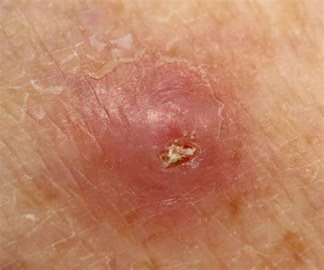 10,000+ Frightening Facts About Cancer Pimples on Head