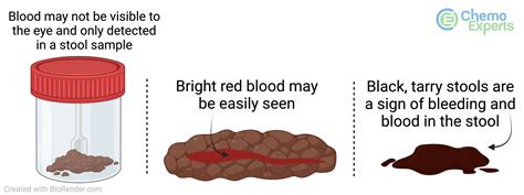 10,000+ Pictures of Blood in Stool from Colon Cancer: A Comprehensive Guide