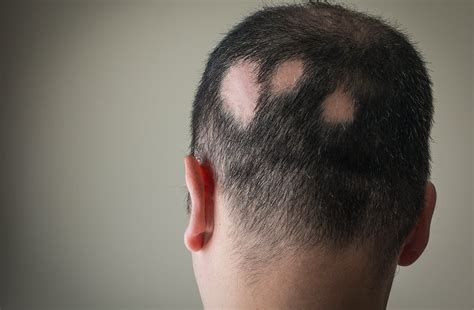 10 Bald Head Patches: Causes, Treatments, and Prevention