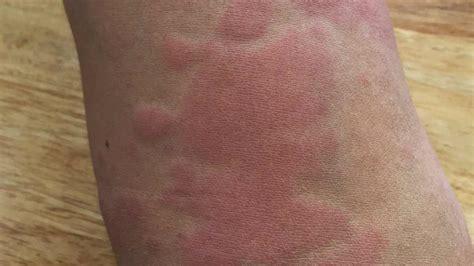 10 Underlying Causes of a Sudden Rash All Over the Body: 2025 Outlook