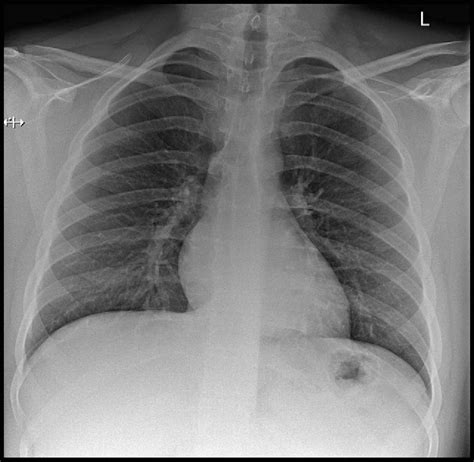 10.0 cm: The Standard Chest X-Ray Measurement