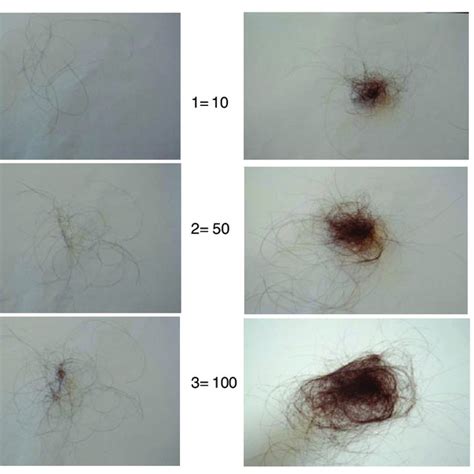 100-150: The Normal Daily Hair Fall Count