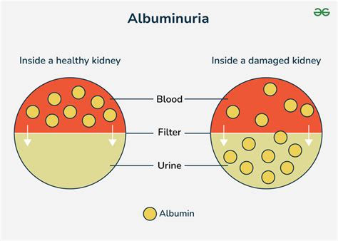 11 Critical Symptoms of Albumin in Urine You Shouldn't Ignore