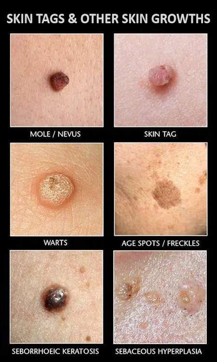 15 Essential Pictures of Cancerous Skin Tags: A Visual Guide