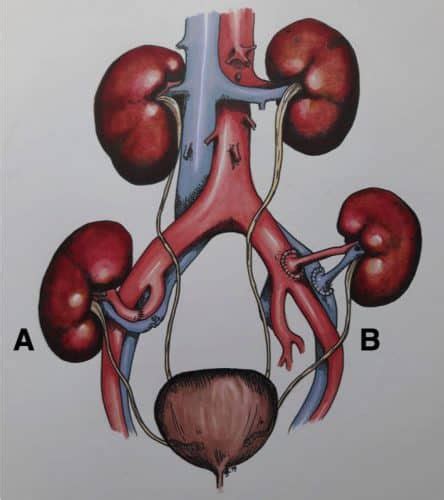 2001 kidney transplant planner Epub