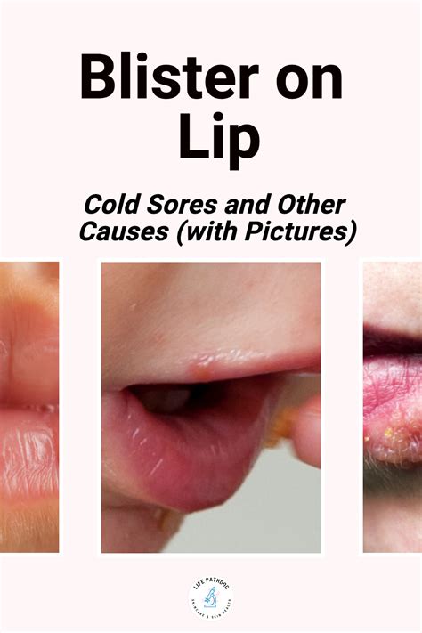 2025's Ultimate Guide: Blister on Lip Not Cold Sore