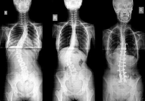 2025: The Ultimate Guide to Identifying Scoliosis: 5 Signs You Need to Know