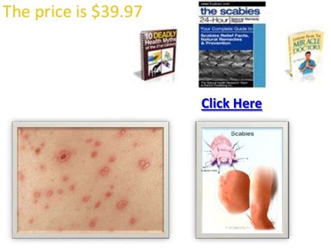 24-Hour Scabies Treatments