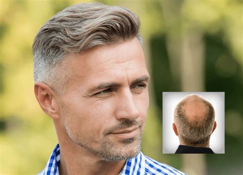 3 Essential Keys for Natural-Looking Men's Hair Systems