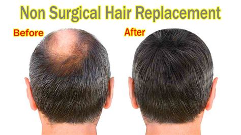 3 Non-Surgical Hair Replacement Options That Will Change Your Life