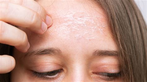 3 Reasons Why You Have Crusty Patches on Your Skin