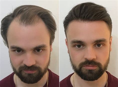 3 Ways Men's Hair Systems Can Transform Your Life in 2023