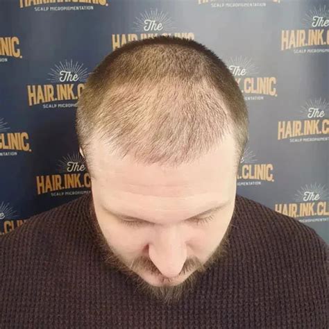 33 Balding Crown Hairstyles to Revitalize Your Look