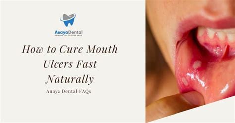 33 Proven Ways to Cure Ulcer on Tongue Faster in 2025