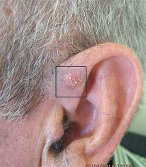 35 Frightening Photos of Skin Cancer on Ears You Need to See