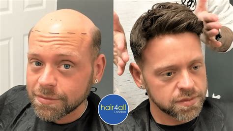 360 Male Hair Units: A Revolutionary Solution for Hair Loss